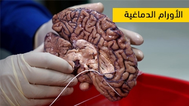 الأورام الدماغية