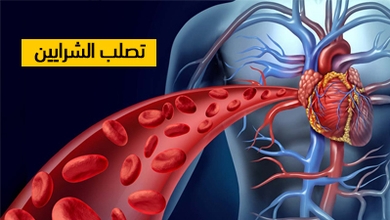 تصلب الشرايين