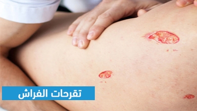 تقرحات الفراش