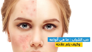 حب الشباب: ما هي أنواعه وكيف يتم علاجه