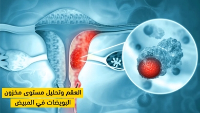 العقم وتحليل مستوى مخزون البويضات في المبيض