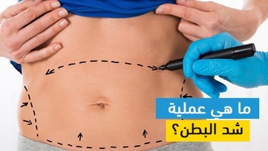 ما هي عملية شد البطن؟