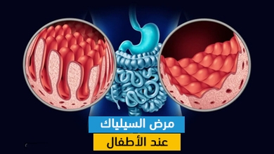 مرض السيلياك عند الأطفال