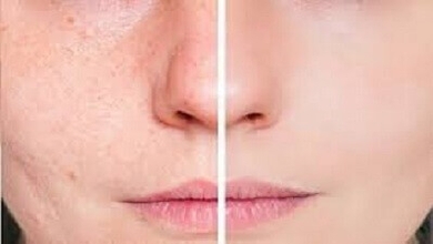 Voici comment se débarrasser des taches brunes naturellement