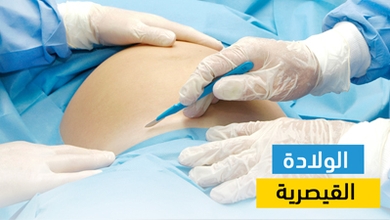 الولادة القيصرية