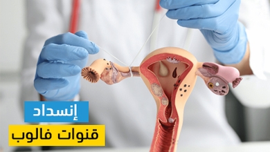 إنسداد قنوات فالوب