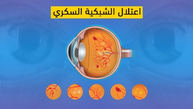 اعتلال الشبكية السكري