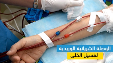 الوصلة الشريانية الوريدية لغسيل الكلى