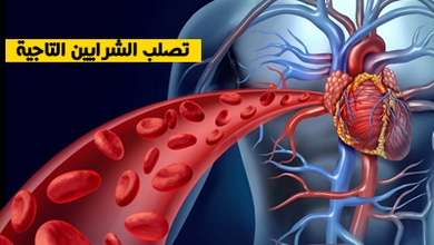 تصلب الشرايين التاجية