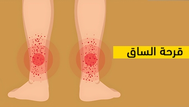 قرحة الساق