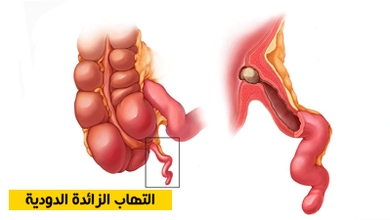 التهاب الزائدة الدودية