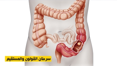 سرطان القولون والمستقيم