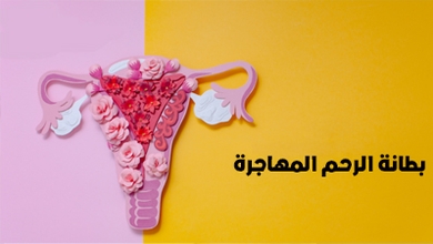بطانة الرحم المهاجرة