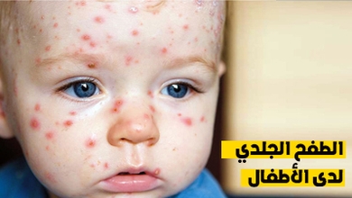 الطفح الجلدي لدى الأطفال