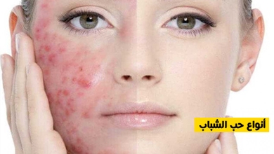 أنواع حب الشباب