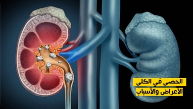 الحصى في الكلى : الأعراض والأسباب