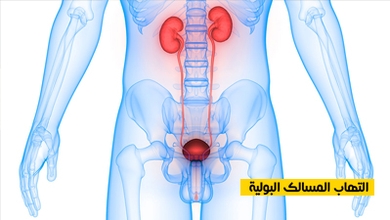 التهاب المسالك البولية