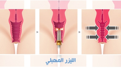 الليزر المهبلي