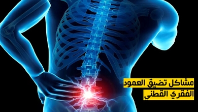 مشاكل تضيق العمود الفقري القطني