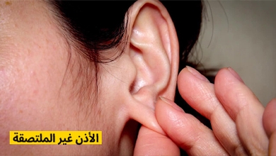 الأذن غير الملتصقة