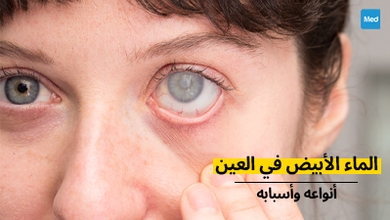 الماء الأبيض في العين : أنواعه وأسبابه