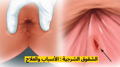 الشقوق الشرجية : الأسباب والعلاج