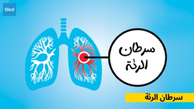 سرطان الرئة