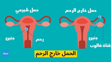 الحمل خارج الرحم
