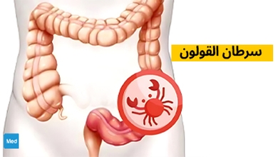 سرطان القولون