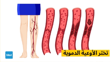تخثر الأوعية الدموية