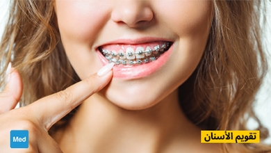 تقويم الأسنان