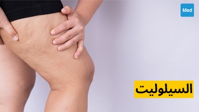 السيلوليت