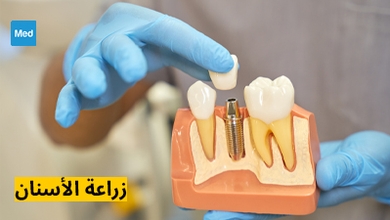 زراعة الأسنان