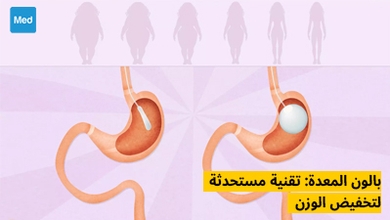 بالون المعدة: تقنية مستحدثة لتخفيض الوزن