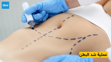 عملية شد البطن