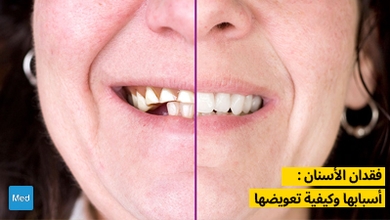فقدان الأسنان : أسبابها وكيفية تعويضها