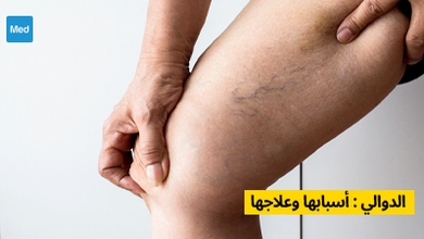 الدوالي : أسبابها وعلاجها