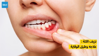نزيف اللثة: كيفية التعامل معه والوقاية منه