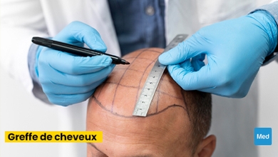 La Greffe de Cheveux : Restaurer la Beauté Naturelle et la Confiance en Soi