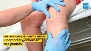 Comprendre et Gérer les Varices : Causes, Symptômes et Solutions