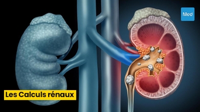 La Lithiase Urinaire : De la Chirurgie à la Prévention 