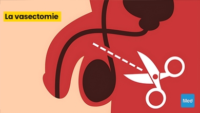 Comprendre la Vasectomie