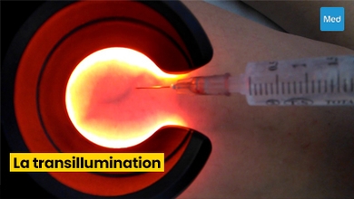 Varicosités et Telangiectasies : Comprendre et Traiter les Problèmes Veineux Cutanés