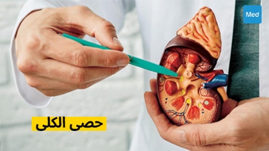 حصى الكلى: الأسباب والأعراض والعلاج