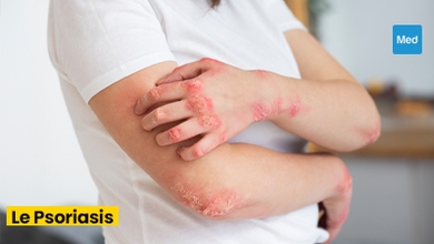 Psoriasis : comprendre la maladie et vivre au mieux