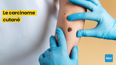  Tout ce que vous devez savoir sur le carcinome cutané