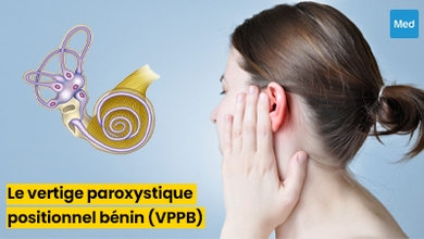 Le Vertige Paroxystique Positionnel Bénin (VPPB)