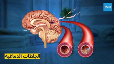 الجلطات الدماغية: الأسباب، الأعراض، التشخيص، والعلاج