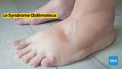 Comprendre le Syndrome Œdémateux : Symptômes, Causes, Diagnostic et Traitement