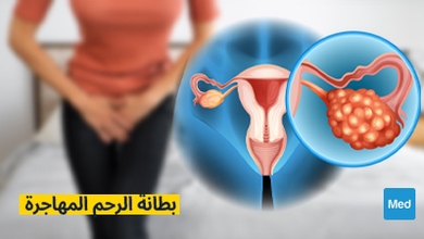 بطانة الرحم المهاجرة
